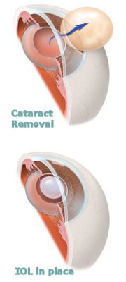 Houston Cataract Surgery